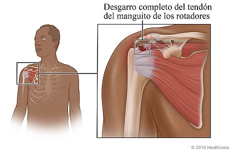 Ubicación del manguito de los rotadores en el hombro, con detalle de desgarro completo del manguito de los rotadores