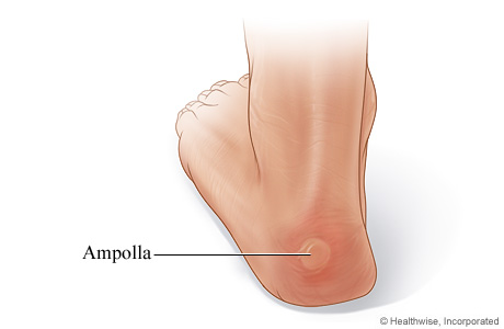 Ampollas en los pies.