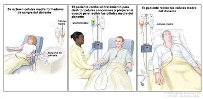 Trasplante de células madre de un donante. Se observan tres paneles. Panel 1: en el dibujo se muestra la extracción de células madre del torrente sanguíneo de una donante mediante una máquina de aféresis. Se extrae sangre de una vena del brazo y se la hace pasar por la máquina que separa las células madre. La sangre que queda se devuelve a la donante por una vena del otro brazo. Panel 2: en el dibujo se observa a una proveedora de atención de la salud que administra una infusión de quimioterapia a un paciente mediante un catéter en el tórax. La quimioterapia se administra para destruir células cancerosas y preparar el cuerpo del paciente para recibir las células madre del donante. Panel 3: en el dibujo se observa a un paciente que recibe una infusión de las células madre del donante a través de un catéter en el tórax.