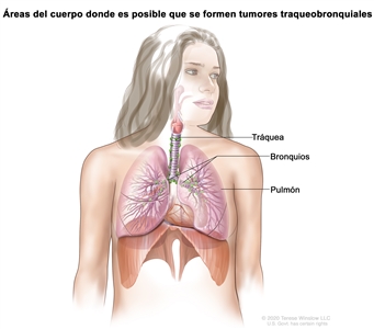 En el dibujo de una mujer se observan las áreas del cuerpo donde es posible que se formen tumores traqueobronquiales y se señalan la tráquea, los bronquios (conductos grandes por donde pasa el aire a los pulmones) y un pulmón.