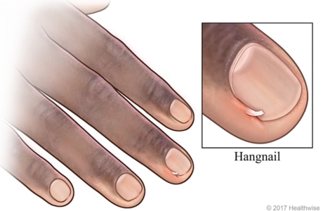 Hangnail