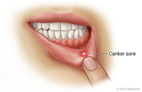 Lip pulled back to show canker sore on inside of lower lip.