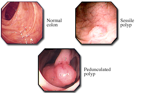 Colon polyps visible with a sigmoidoscope