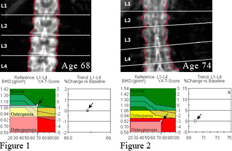 Bone density of spine