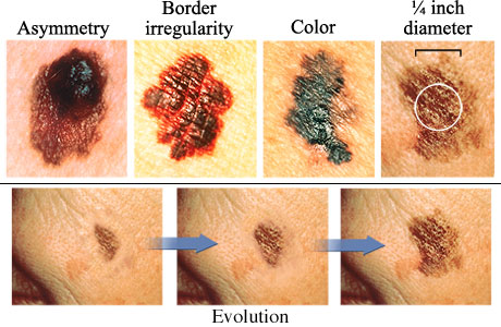 Photos of various melanoma, showing one with asymmetry, one with border irregularity, one with varied color, and one larger than Â¼ inch, and three images showing evolution of size of melanoma.