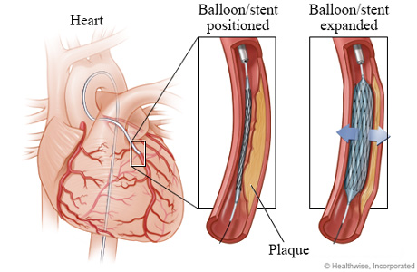 Balloon and stent positioned and expanded