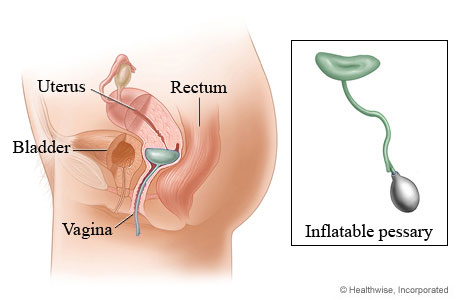 Inflatable pessary