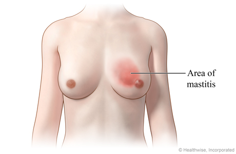 Picture of mastitis (inflammation of the breast)