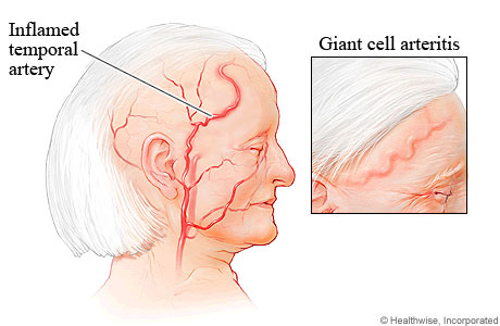 Giant cell arteritis