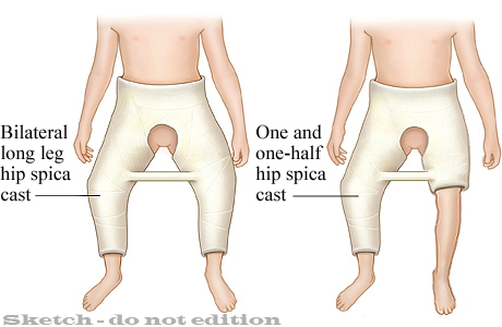 Two different types of spica cast with a bar