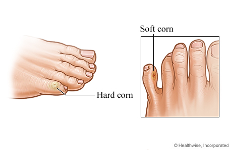 Painful soft corns between toes online