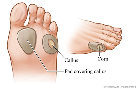 Corn on inside of pinky toe deals