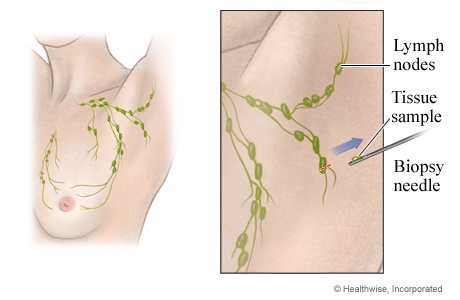 Core needle lymph node biopsy