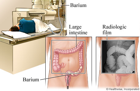 Barium enema and how it looks on an X-ray