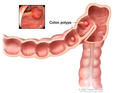 Colon polyps; shows two polyps (one flat and one pedunculated) inside the colon. Inset shows photo of a pedunculated polyp.