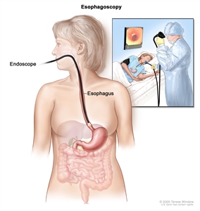 Esophagoscopy; shows endoscope inserted through the mouth and into the esophagus. Inset shows patient on table having an esophagoscopy.