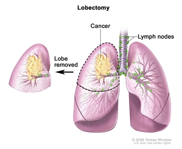 Lobectomy; drawing shows lobes of both lungs, trachea, bronchi, bronchioles, and lymph nodes. Cancer is shown in one lobe. The removed lobe is shown next to the lung from which it was removed.