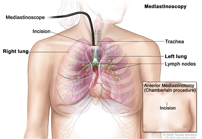 Mediastinoscopy; shows mediastinoscope with light and lens inserted into the chest through an incision above the breastbone. Drawing shows right and left lungs, trachea, and lymph nodes. Inset shows anterior mediastinotomy (Chamberlain procedure) with incision beside the breastbone.