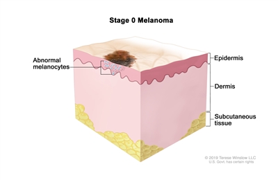 Stage 0 melanoma; drawing shows an abnormal area on the surface of the skin and abnormal melanocytes in the epidermis (outer layer of the skin). Also shown are the dermis (inner layer of the skin) and the subcutaneous tissue below the dermis.