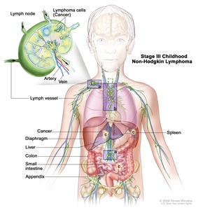 Stage III childhood non-Hodgkin lymphoma; drawing shows cancer in lymph node groups above and below the diaphragm, in the chest, and throughout the abdomen in the liver, spleen, small intestines, and appendix. The colon is also shown. An inset shows a lymph node with a lymph vessel, an artery, and a vein. Lymphoma cells containing cancer are shown in the lymph node.