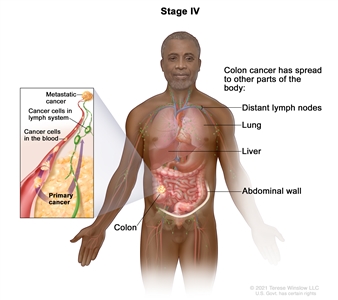 Stage IV colon cancer; drawing shows other parts of the body where colon cancer may spread, including the distant lymph nodes, lung, liver, and abdominal wall. An inset shows cancer cells spreading from the colon, through the blood and lymph system, to another part of the body where metastatic cancer has formed.