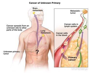 Cancer of unknown primary; drawing shows a primary tumor that has spread from an unknown site to other parts of the body (the lung and the brain). An inset shows cancer cells spreading from the primary cancer, through the blood and lymph systems, to another part of the body where a metastatic tumor has formed.