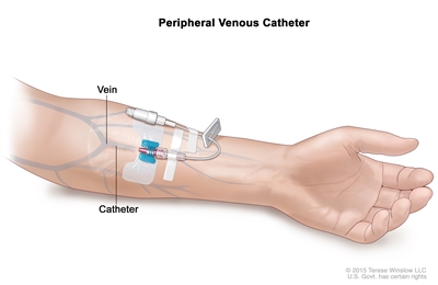 Peripheral venous catheter; drawing of a peripheral venous catheter in a vein in the lower part of the arm with the catheter tubing clamped and capped off at the end.