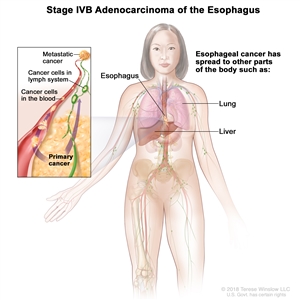 Stage IVB adenocarcinoma of the esophagus; drawing showing other parts of the body where esophagus cancer may spread, including the lung and liver. An inset shows cancer cells spreading from the esophagus, through the blood and lymph system, to another part of the body where metastatic cancer has formed.