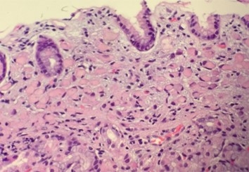 High-power image of a gastric biopsy tissue sample showing signet ring cell carcinoma.