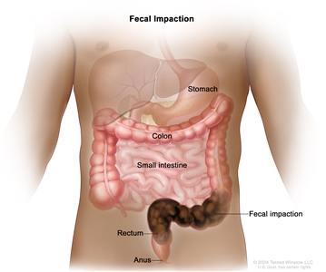 Fecal impaction; drawing showing a mass of dark brown stool in the last part of the colon and in the rectum. The stomach, small intestine, and anus are also shown.