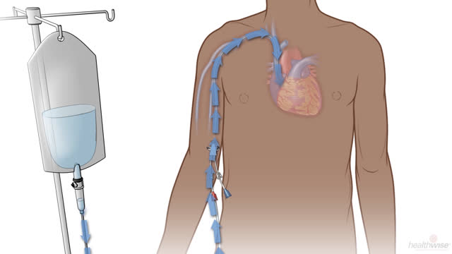 Getting Treatment Through a PICC or Central Line