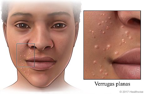 Zona del costado de la cara cubierta con pequeñas verrugas planas con primer plano de pequeñas protuberancias