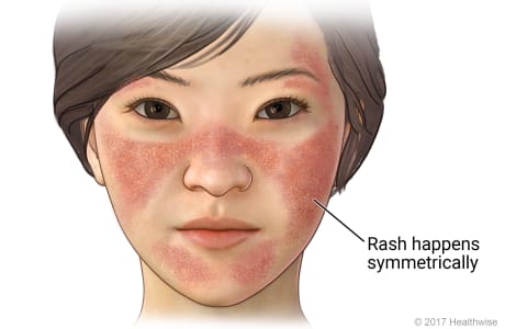 Picture of typical places where lupus rash appears