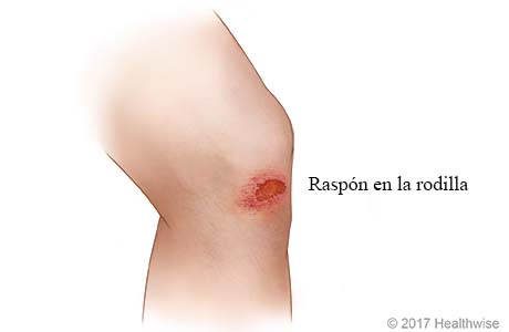 Ilustración de un raspón en la rodilla