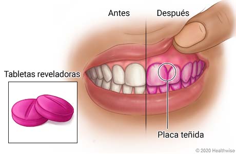 Placa en los dientes teñida de rojo por tabletas reveladoras, con detalle de las tabletas reveladoras.