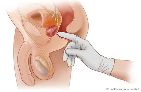 Examen de tacto rectal