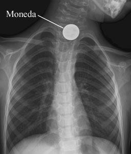 Radiografía de un objeto tragado