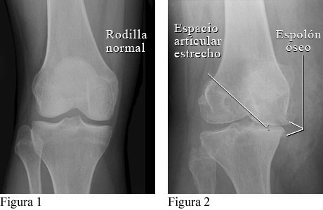 Radiografía de osteoartritis de la rodilla