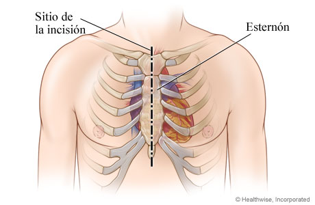 Ubicación de incisión en el pecho