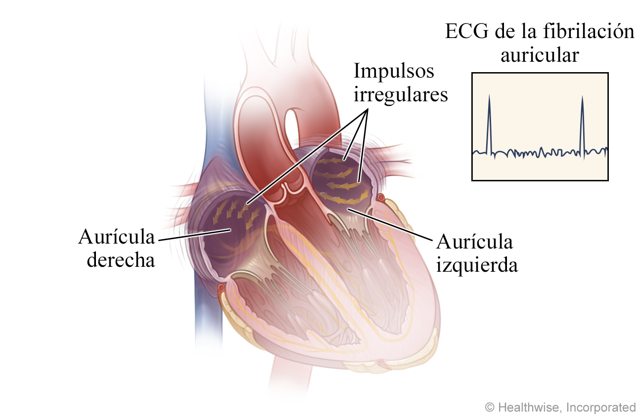 Cómo sucede la fibrilación auricular