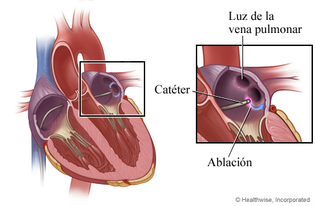 Se destruye tejido cardíaco (ablación)