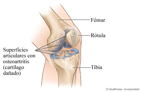 Osteoartritis de la rodilla