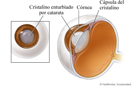 Cristalino enturbiado por catarata