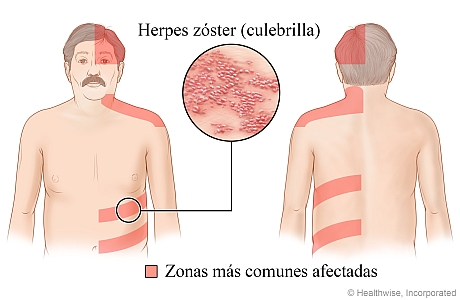 Detalle del salpullido de la culebrilla y zonas en las que suele aparecer la culebrilla: mitad superior de la cabeza, cuello y hombros, y zona del abdomen o de la espalda