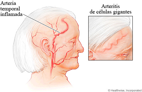 Arteritis de células gigantes