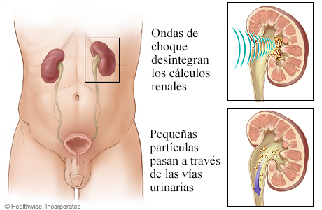 Cómo funciona la litotricia para los cálculos renales