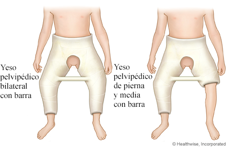 Dos tipos diferentes de yeso en espica con barra