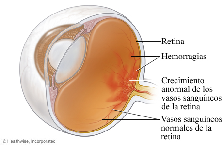 Retinopatía diabética