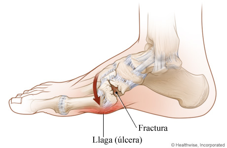 Imagen de pie de Charcot