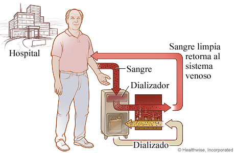 El proceso de hemodiálisis.